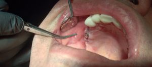 Dental Suture Non Absorbable Polyamide Monamide (PA)
